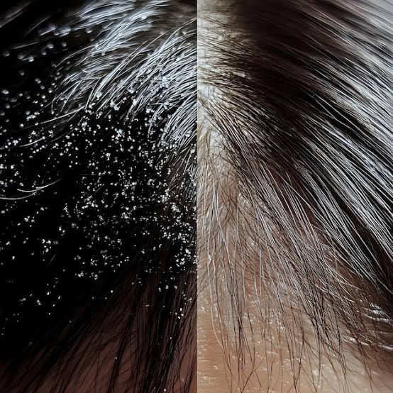 Hair & Scalp Care (केस गळणे व कोंडा उपाय)