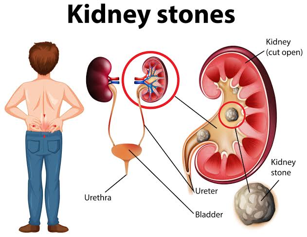 Kidney Stone Treatment (मुतखडा उपचार)