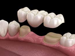 Dental Bridge — Dentist4u