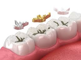 Dental Fillings — Dentist4u