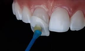 Dental Veneers — Dentist4u