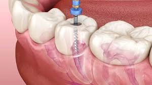Root Canal Treatment (RCT) — Dentist4u