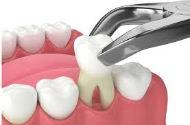 Tooth Extraction — Dentist4u